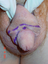 Penile Revisonary Surgery - Penis Silicone Injections