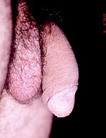 Penis Enlargement Photo
