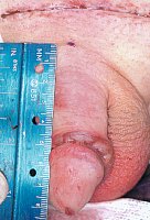 Buried penis corrected with penlie lengthening, pubic lipectomy and sisertion of Allograft dermal matrix graft.