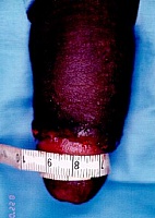 large penis - penis enlargement