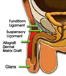 Penile Enlargement Surgery